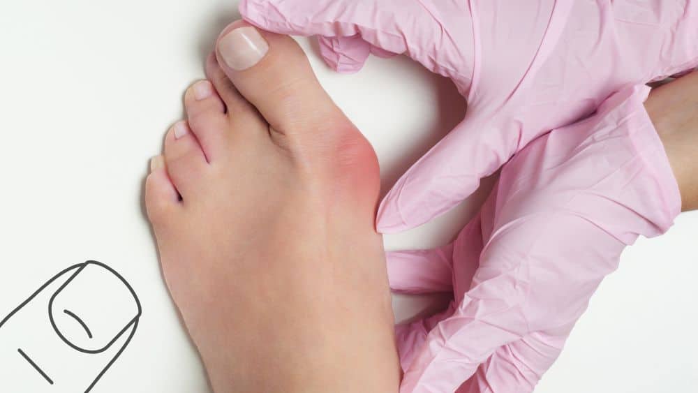 Magnetoterapia per alluce valgo